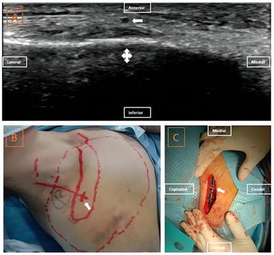 Case Report and Preliminary Exploration: Protection of Supraclavicular Nerve Branches during Internal Fixation of Clavicular Fractures through Preoperative Ultrasound Localization